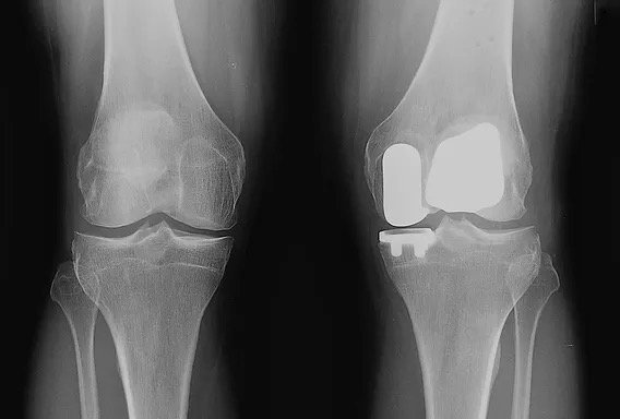 X-ray of a knee after bicompartmental partial knee replacement.