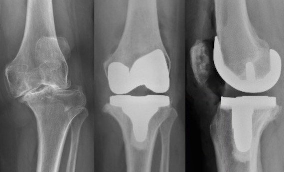 X-rays of a knee before and after complex robotic total knee replacement by Dr. Buechel