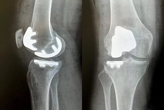 X-rays of a knee after lateral and patellofemoral partial knee replacement.