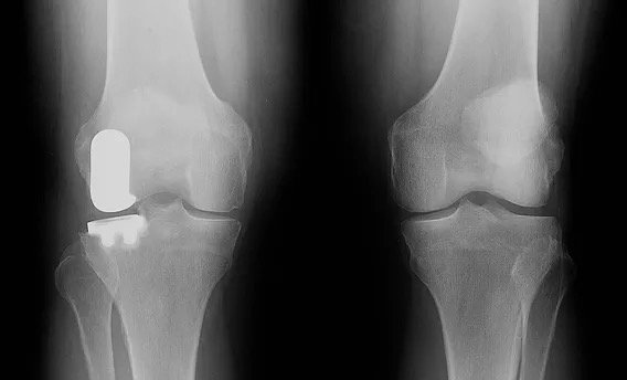 X-ray of a knee after lateral partial knee replacement