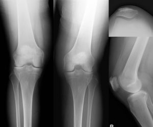 X-rays of a knee joint with indication for Lateral Partial Knee Replacement