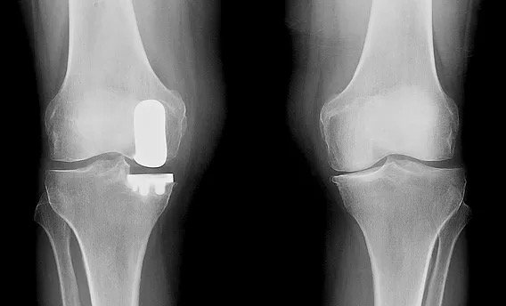 X-ray of a knee after medial partial knee replacement.