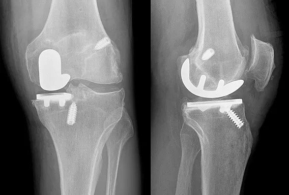 Knee X-rays after medial partial knee replacement after ACL reconstruction