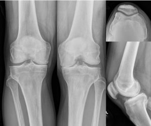 X-rays of a knee joint with indication for Medial Partial Knee Replacement