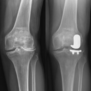 X-rays of patient's knee before and after lateral knee replacement surgery.