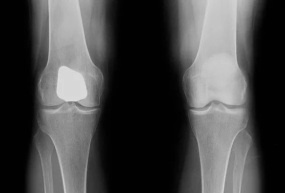 X-ray of a knee after patellofemoral partial knee replacement
