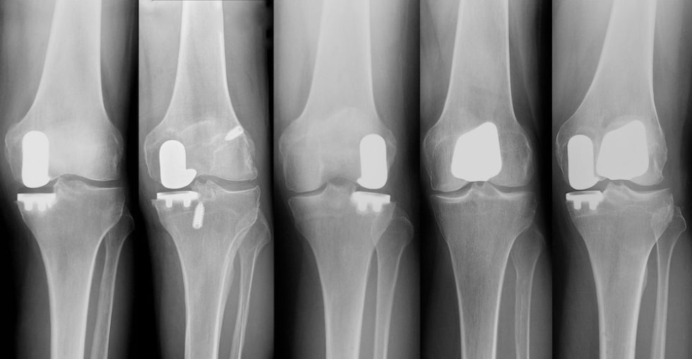 Partial Knee Replacement Options X Ray