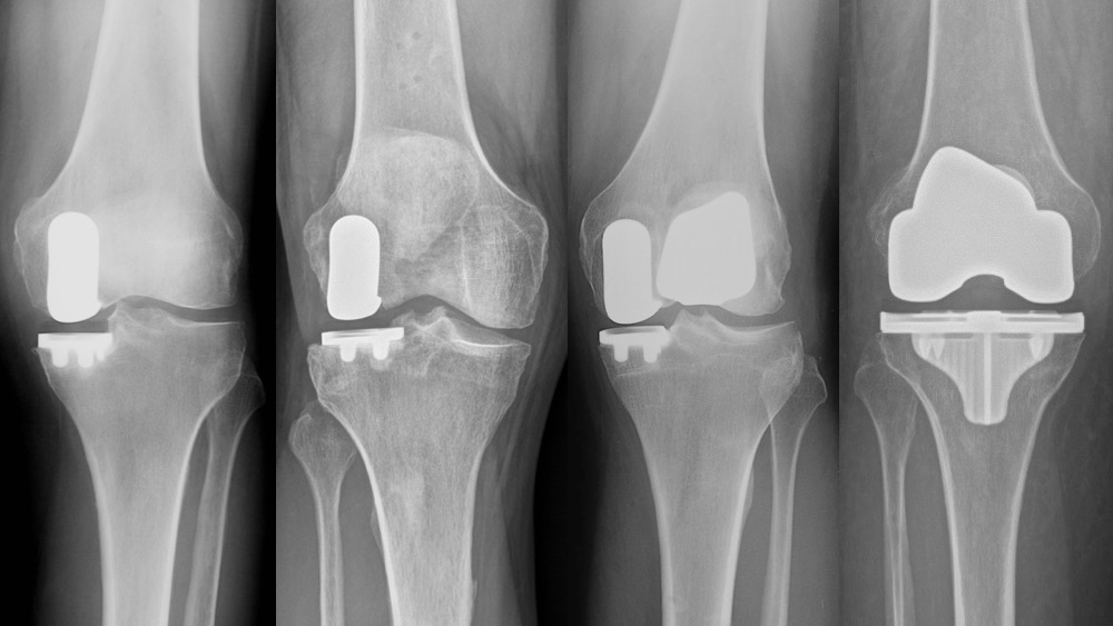 Partial and Total Knee Replacement Xrays