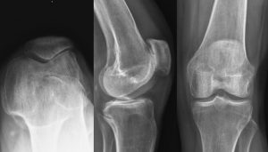 X-rays of a knee joint with indication for Patellofemoral Partial Knee Replacement