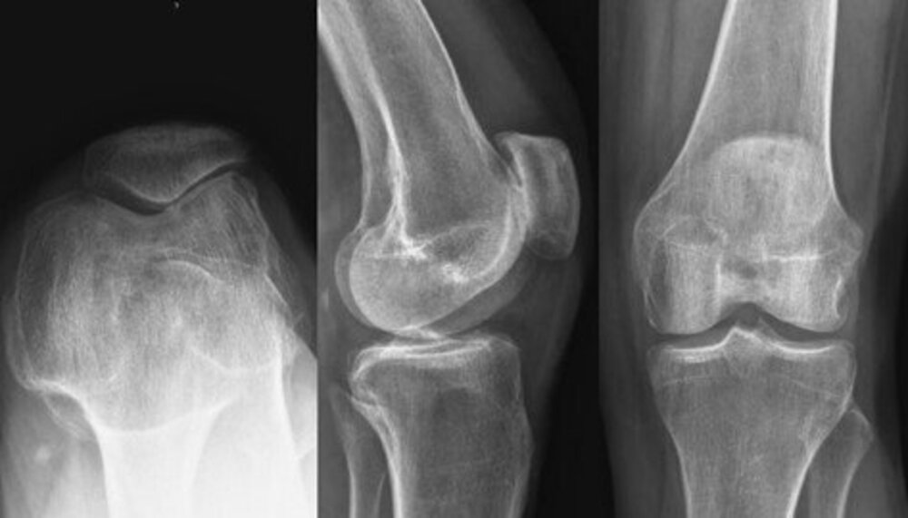 Knee joints X-rays of a patient with painful patellofemoral arthritis.