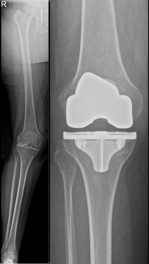 Total Knee Replacement X Ray