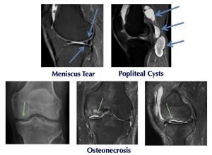 MRI images of Meniscus Tear, Popliteal Cyst and Osteonecrosis