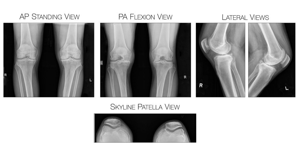 X-rays for Virtual Consultation: AP Standing View, PA Flexion View, Lateral Views ans Skyline Patella View