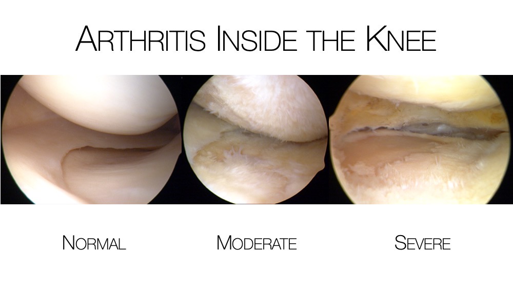 Images of normal, moderate and severe arthritis inside the knee.