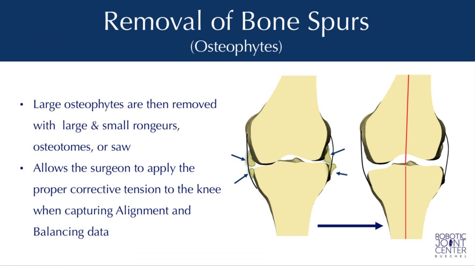 NYC Mako Robotic Total Knee Replacement Dr. Frederick Buechel, Jr.