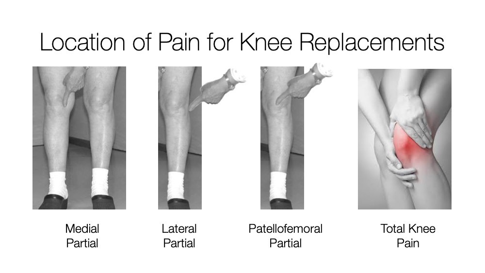 Location of Pain for Knee Replacements