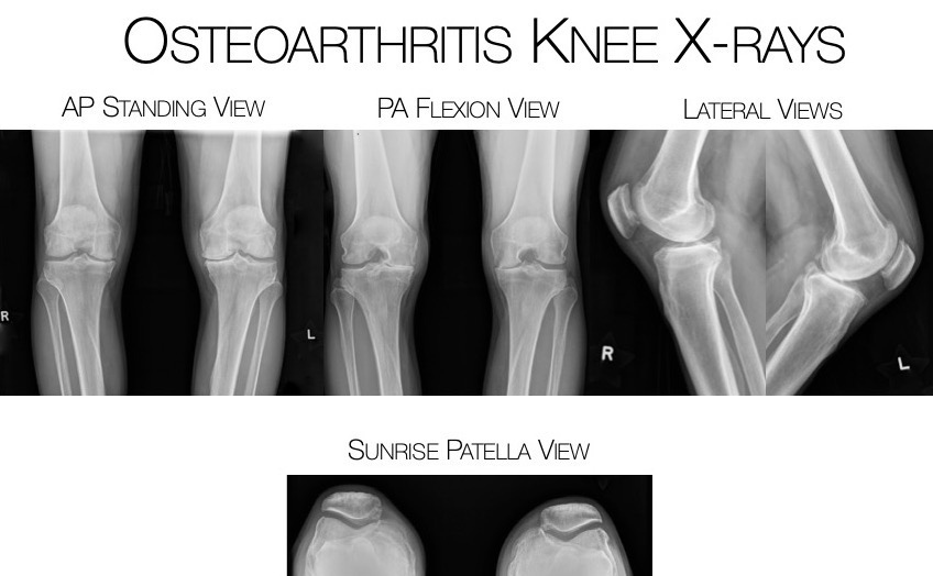 Osteoarthritis Knee X-rays : AP Standing View, PA Flexion View, Lateral Views and Sunrise Patella View