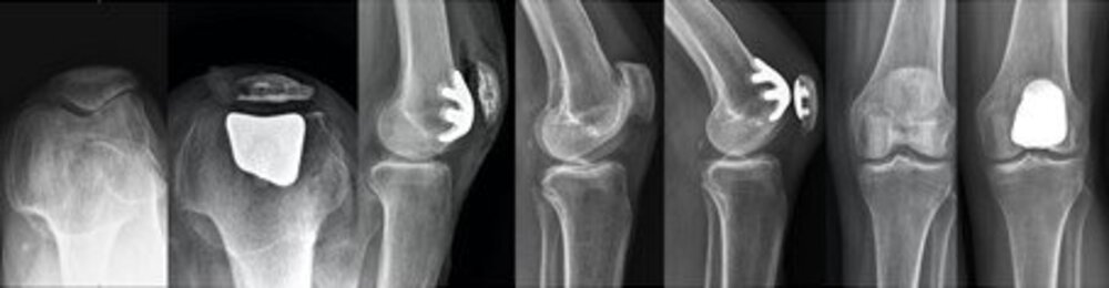 X-rays of a knee joint after patellofemoral partial knee replacement