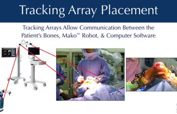 A) Mako robot for total knee arthroplasty. (B) Mako's computer