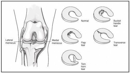 Types of meniscus tear : Flap Tear, Torn Horn Tear, Bucket Handle Tear, Transverse Tear