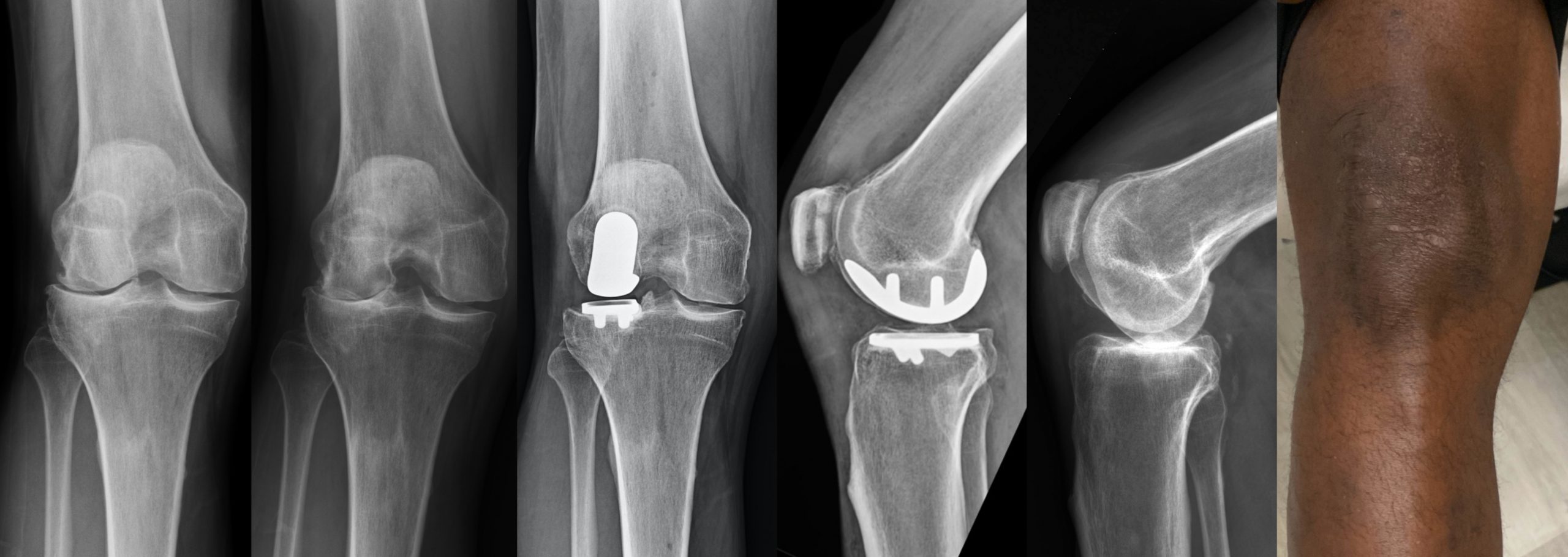 x-rays of a patient's knee before and after lateral partial knee replacement