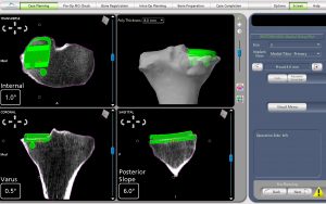 Medial Partial Knee Replacement Pre-operative CT Scans