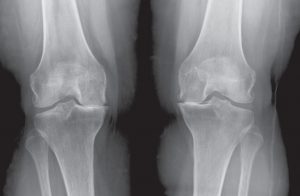knee x-ray of a candidate for medial partial knee replacement
