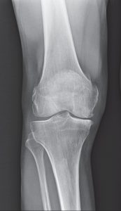 knee x-ray of a candidate for medial partial knee replacement