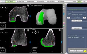 Medial Partial Knee Replacement Pre-operative CT Scans