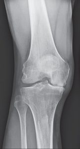 knee x-ray of a candidate for medial partial knee replacement