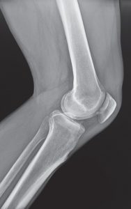 knee x-ray of a candidate for medial partial knee replacement