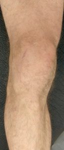patient's knee after lateral partial knee replacement