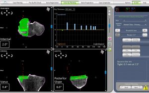 Medial Partial Knee Replacement Intra-operative CT Scans