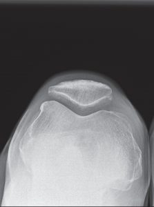 knee x-ray of a candidate for medial partial knee replacement