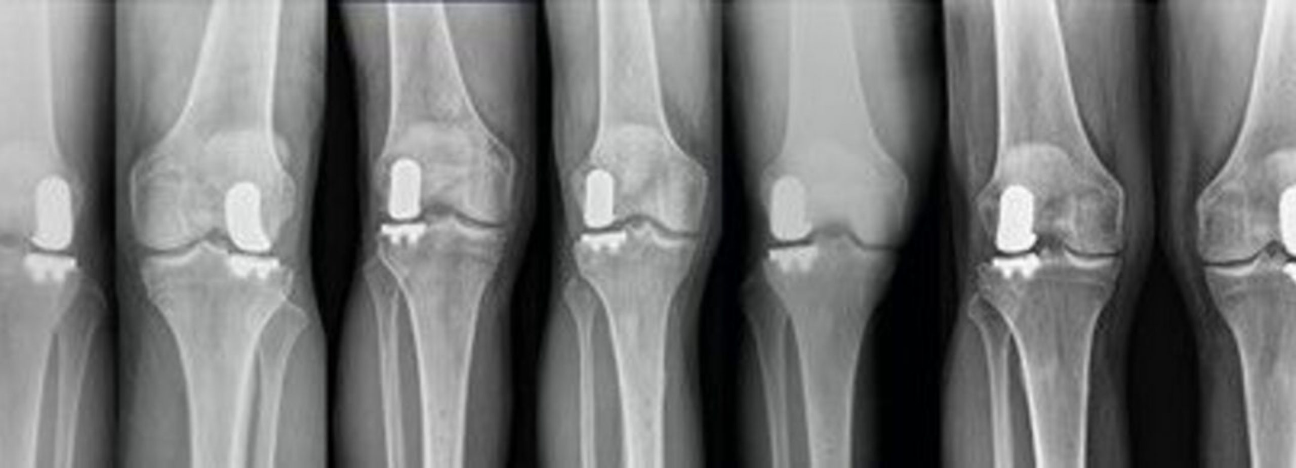 X-rays of patients' knees after lateral partial knee replacements