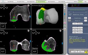 Medial Partial Knee Replacement Intra-operative CT Scans