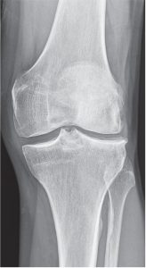 X-ray of a candidate for a lateral partial knee replacement joint