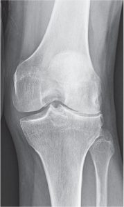 X-ray of a candidate for a lateral partial knee replacement joint