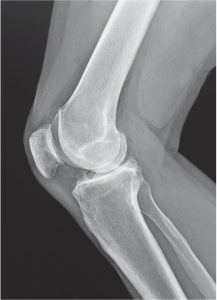 X-ray of a candidate for a lateral partial knee replacement joint