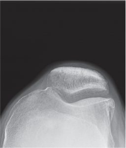 X-ray of a candidate for a lateral partial knee replacement joint