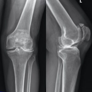 X-ray of a candidate for a lateral partial knee replacement joint