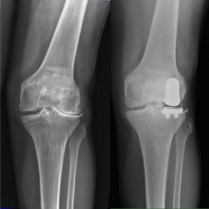 X-ray of a candidate for a lateral partial knee replacement joint