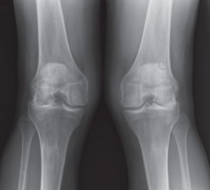 X-rays of patient's knee joints before lateral partial knee replacement surgery.