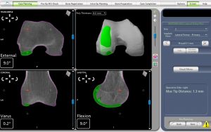 Lateral Partial Knee Replacement Pre-operative CT Scans