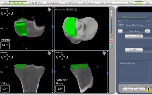 Lateral Partial Knee Replacement Pre-operative CT Scans