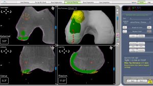 Lateral Partial Knee Replacement Intra-operative CT scanning