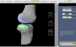Lateral partial knee replacement intra-operative CT scan