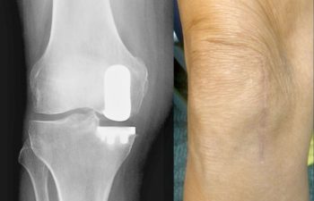 Patient's knee after Mako robotic partial knee replacement surgery.