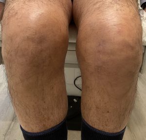 knees of a patient 7 months after medial partial knee replacement surgery