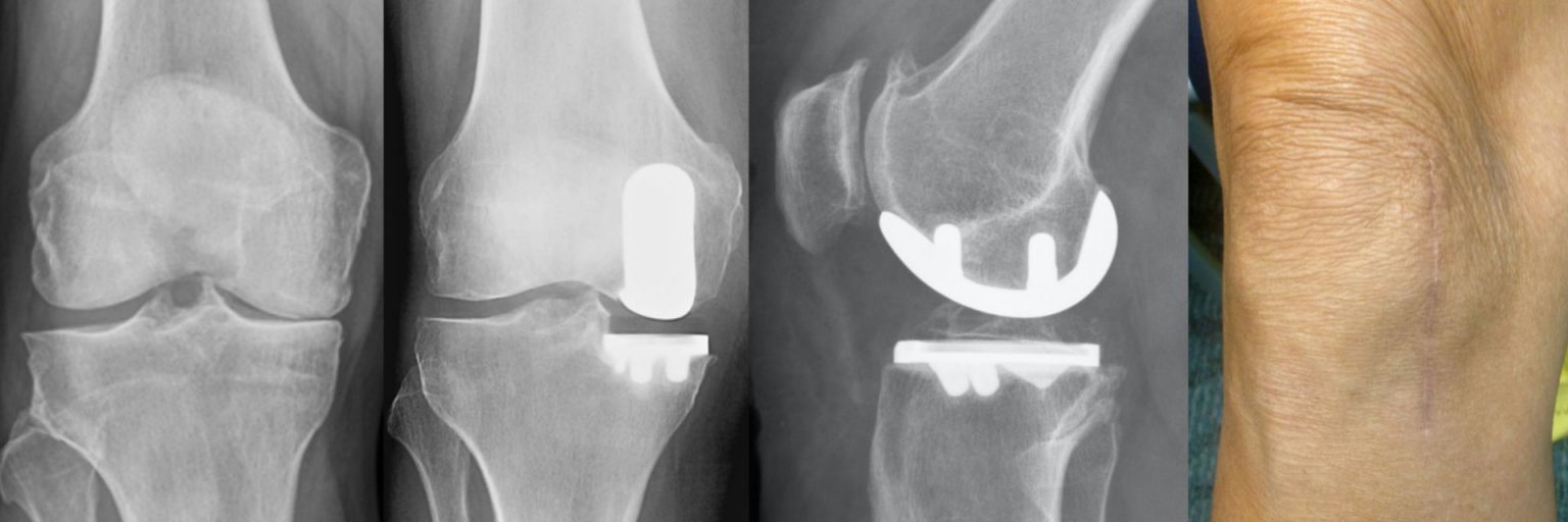NYC Medial Partial Knee Replacement Robotic Partial Knee Replacement